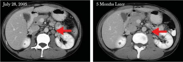 A malignant follicular lymph node tumour, reduced by 50% by the mid-stages of the treatment